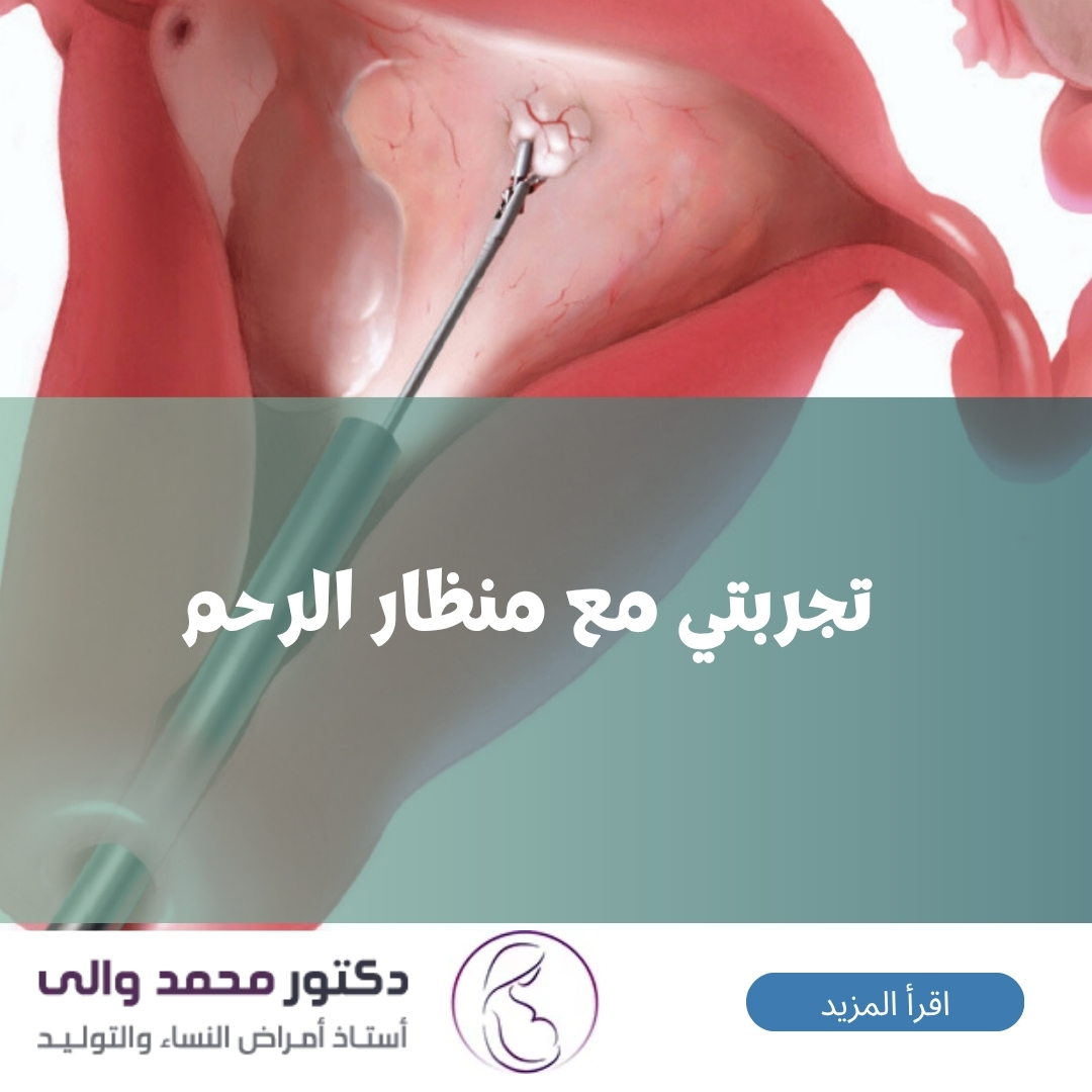 تجربتي مع منظار الرحم
