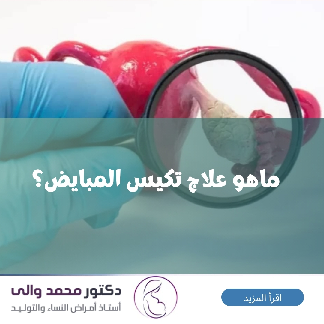 علاج تكيس المبايض