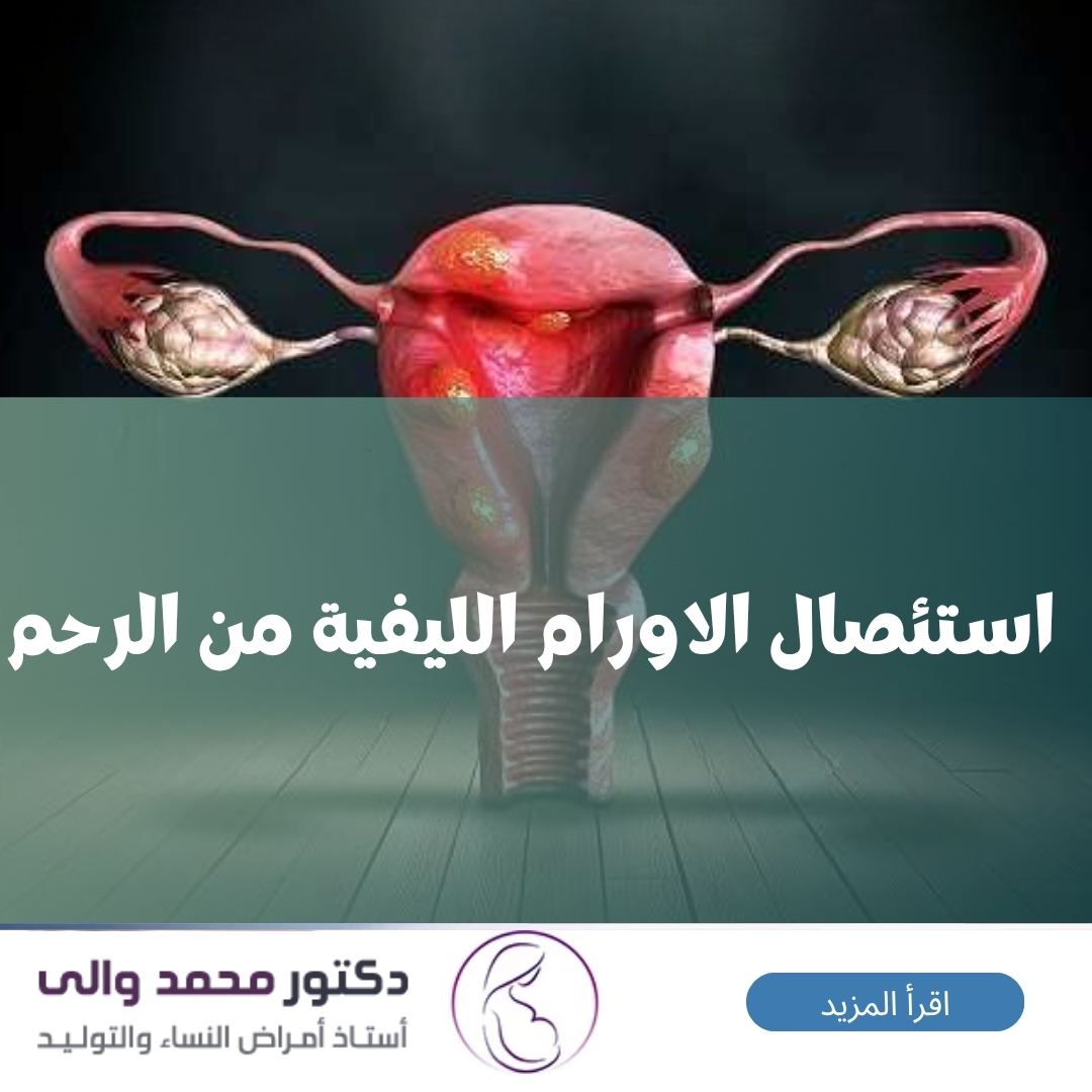 استئصال الاورام الليفية من الرحم