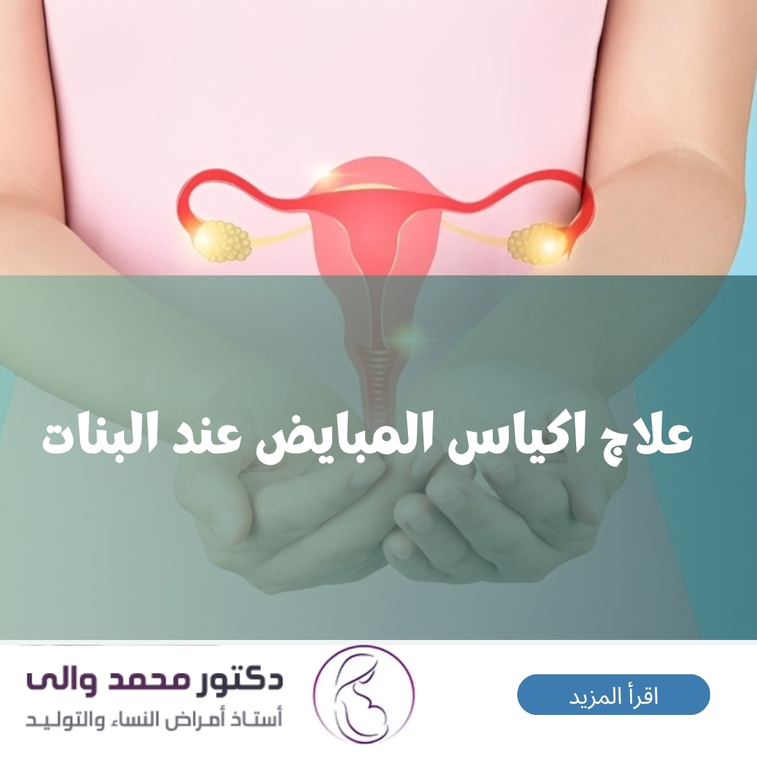 علاج اكياس المبايض عند البنات