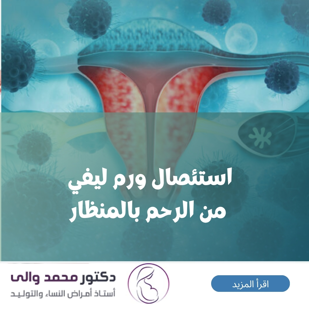 استئصال ورم ليفي من الرحم بالمنظار