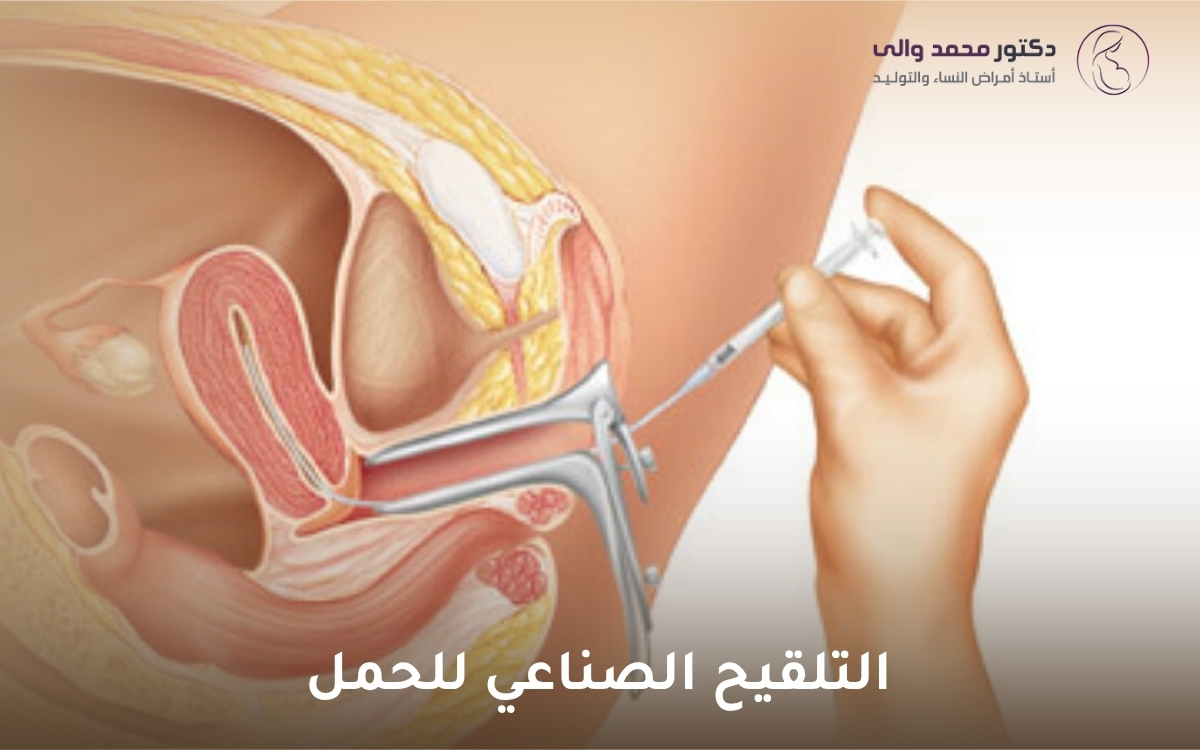التلقيح الصناعي للحمل التلقيح الصناعي للحمل