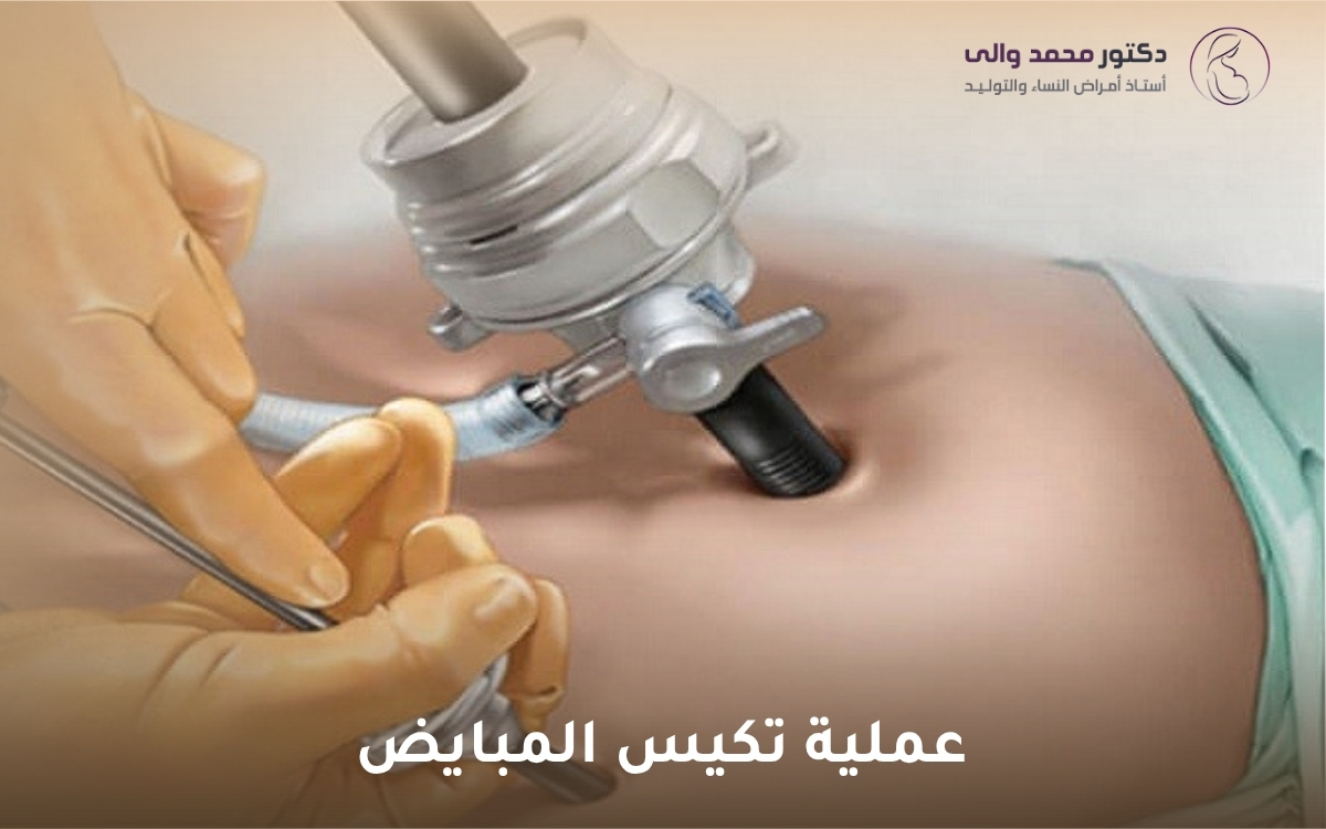 عملية تكيس المبايض