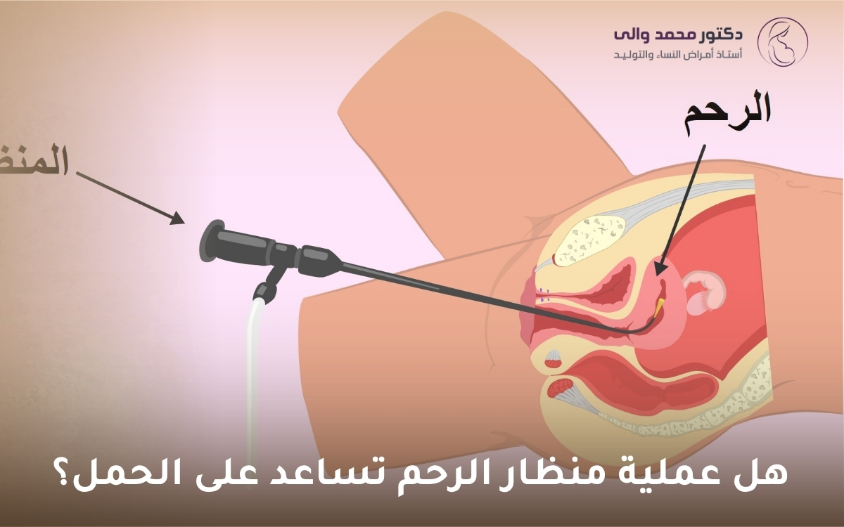 هل عملية منظار الرحم تساعد على الحمل