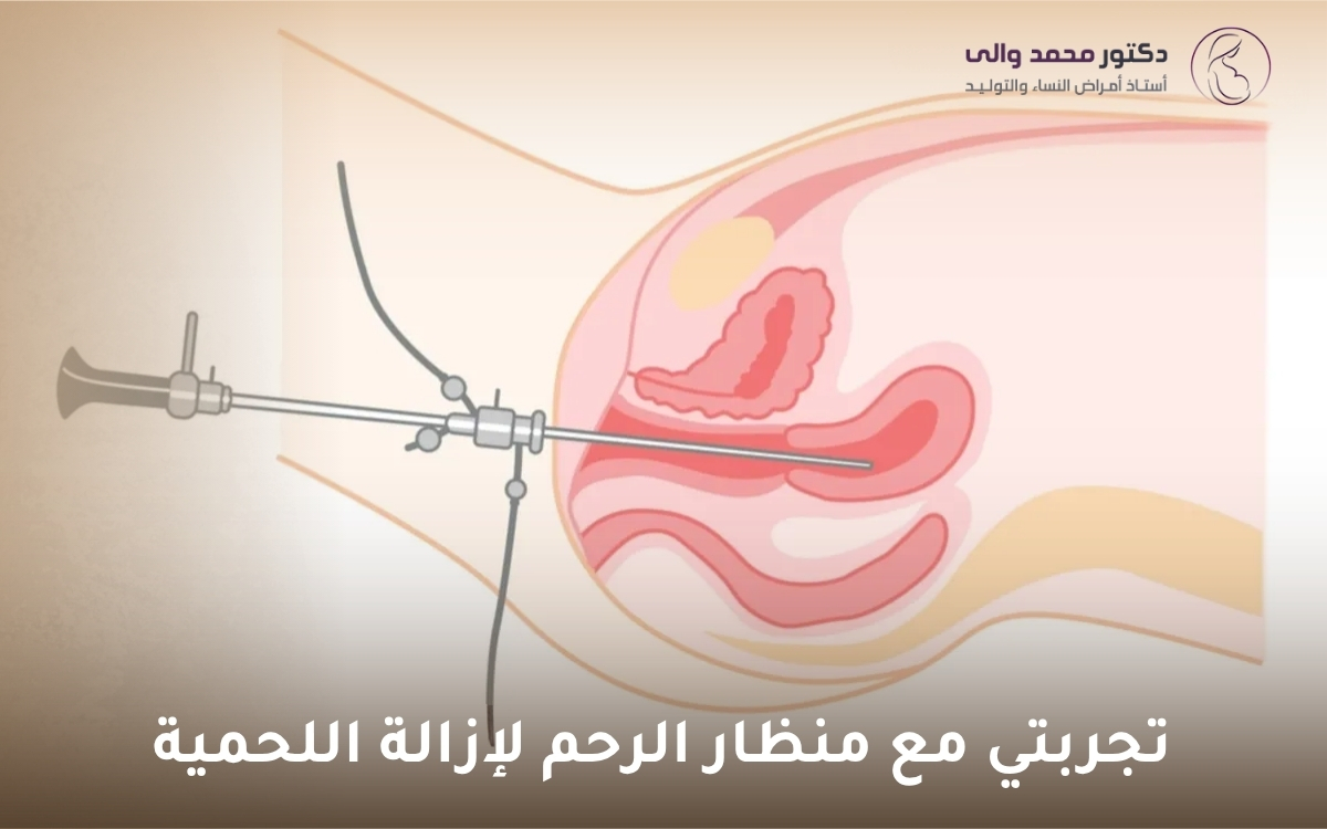 تجربتي مع منظار الرحم لإزالة اللحمية