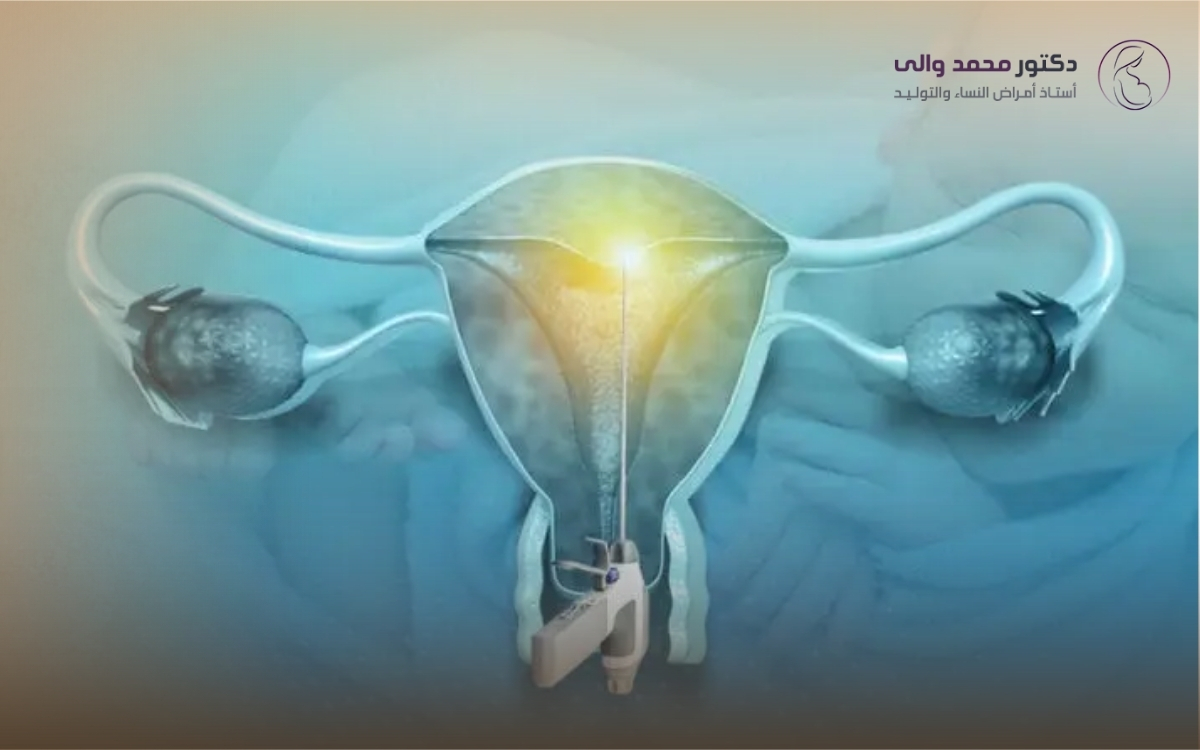 تكلفة عملية استئصال الرحم بالمنظار
