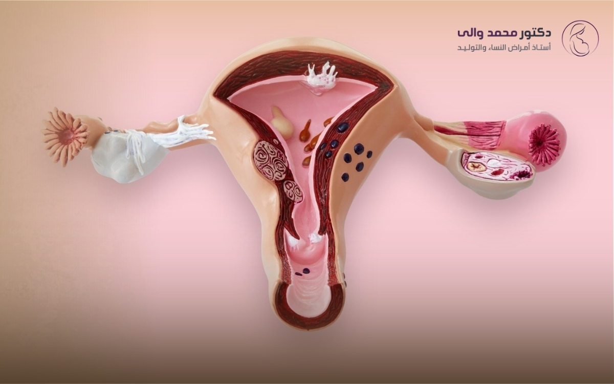 علاج التصاقات الرحم بالمنظار