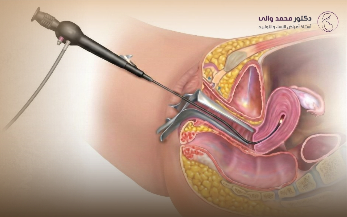 هل عملية منظار الرحم تساعد على الحمل
