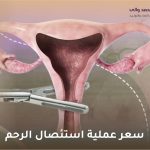 سعر عملية استئصال الرحم