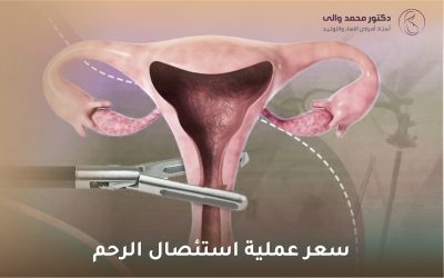 سعر عملية استئصال الرحم: دليل شامل للمريضات