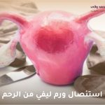 استئصال ورم ليفي من الرحم
