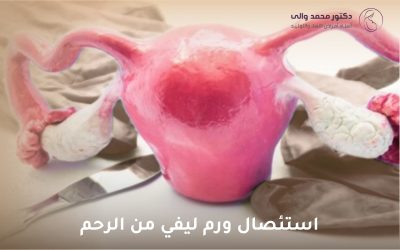 استئصال ورم ليفي من الرحم: كل ما تحتاجين معرفته