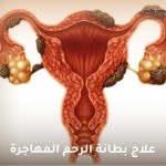 علاج بطانة الرحم المهاجرة