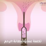 تكلفة عملية بطانة الرحم