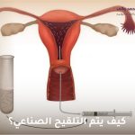 كيف يتم التلقيح الصناعي