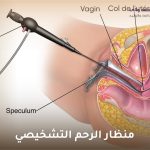 منظار الرحم التشخيصي