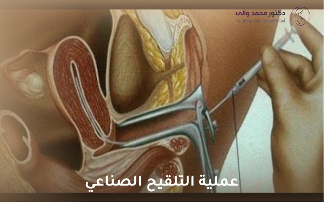 عملية التلقيح الصناعي