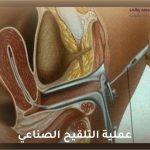 عملية التلقيح الصناعي