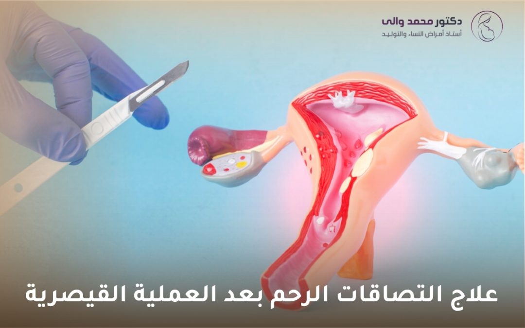 علاج التصاقات الرحم بعد العملية القيصرية