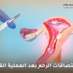 علاج التصاقات الرحم بعد العملية القيصرية