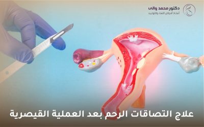 علاج التصاقات الرحم بعد العملية القيصرية: دليل شامل للتعافي والوقاية