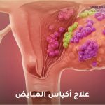 علاج أكياس المبايض