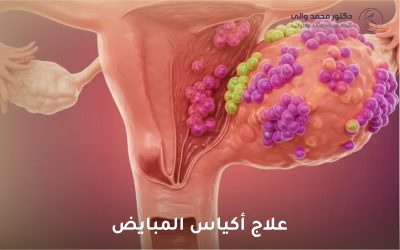 علاج أكياس المبايض: دليل شامل للتشخيص والعلاج والوقاية
