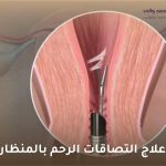 علاج التصاقات الرحم بالمنظار