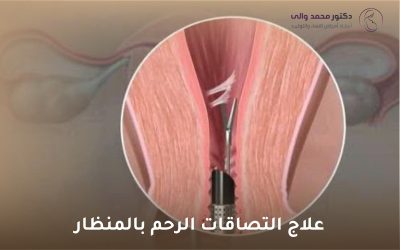 علاج التصاقات الرحم بالمنظار: الحل الأمثل لاستعادة الخصوبة والصحة الإنجابية