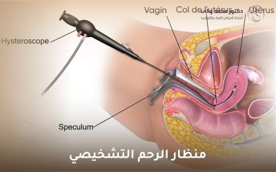 منظار الرحم التشخيصي: دليل شامل لفهم الإجراء وفوائده