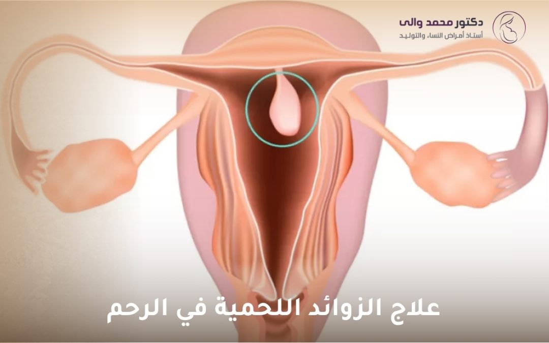 علاج الزوائد اللحمية في الرحم
