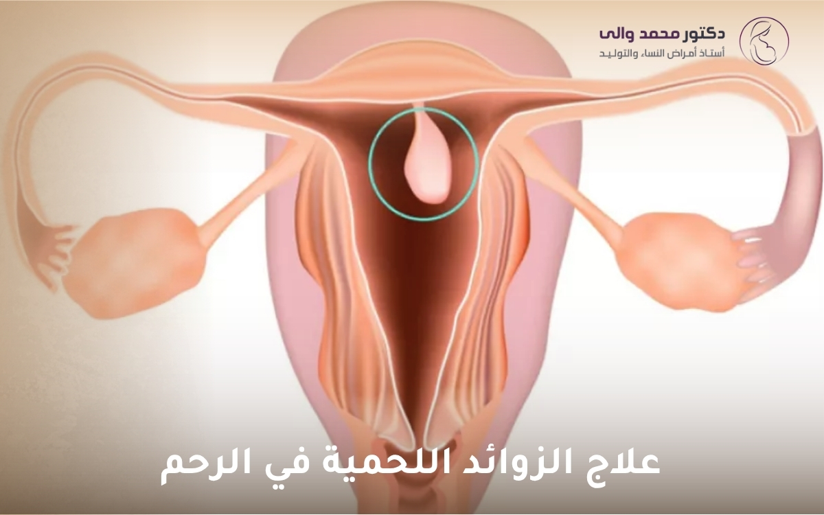 علاج الزوائد اللحمية في الرحم علاج الزوائد اللحمية في الرحم