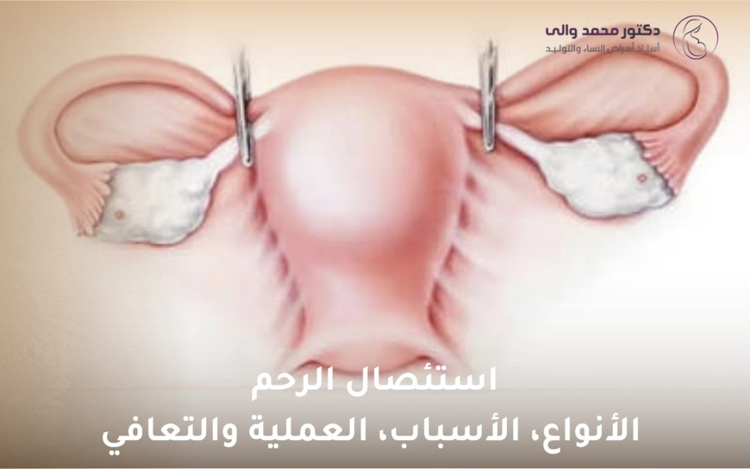 دليل استئصال الرحم