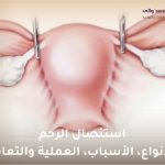دليل استئصال الرحم