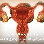 بطانة الرحم المهاجرة