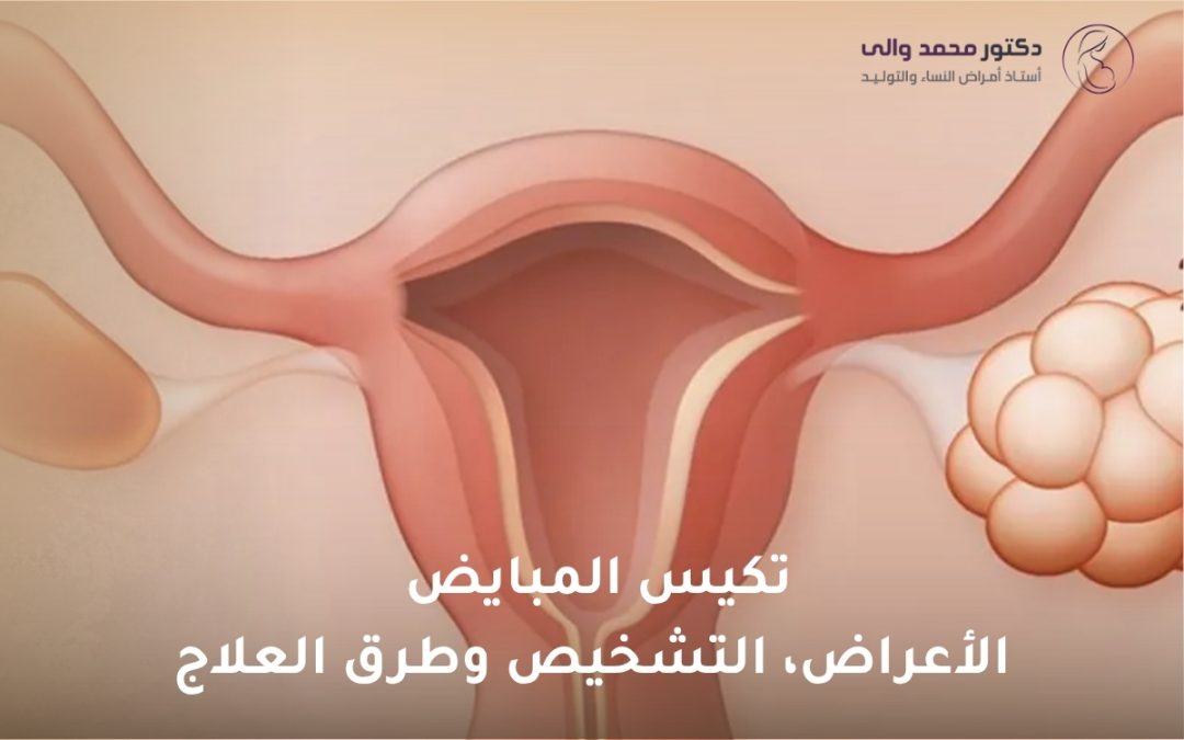 تكيس المبايض