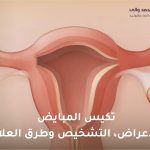 تكيس المبايض