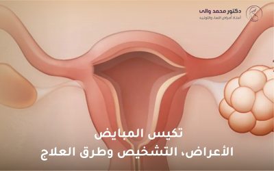 دليل تكيس المبايض: الأعراض والتشخيص وطرق العلاج وتأثيره على الحمل