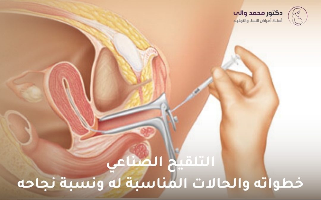 التلقيح الصناعي
