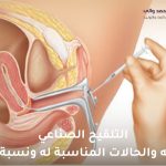 التلقيح الصناعي