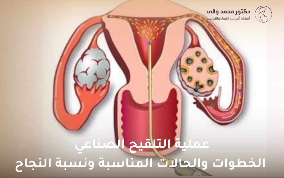 عملية التلقيح الصناعي